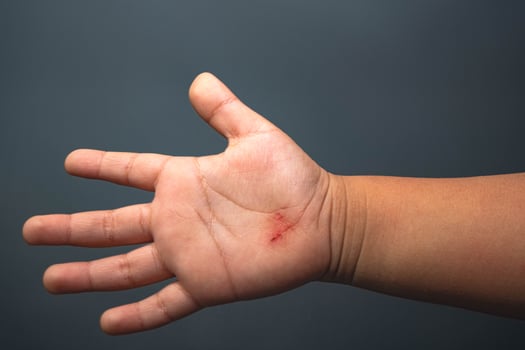 Red wound on the palms of small children. First aid in wound treatment. Treatment of wounds. photo