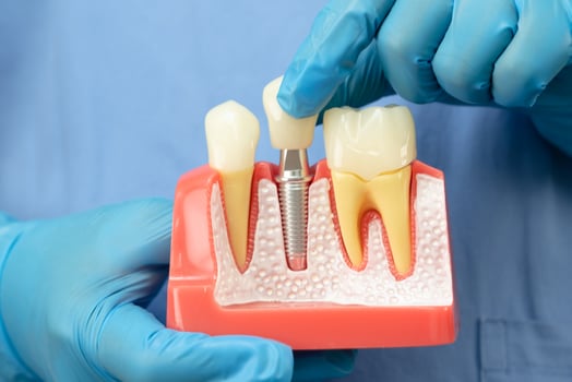 Asian dentist holding dental implant, artificial tooth roots into jaw, root canal of dental treatment, gum disease, teeth model for dentist. photo