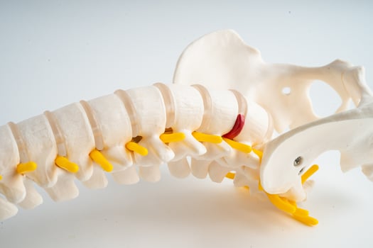 Lumbar spine displaced herniated disc fragment, spinal nerve and bone. Model for treatment medical in the orthopedic department. photo