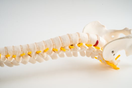 Lumbar spine displaced herniated disc fragment, spinal nerve and bone. Model for treatment medical in the orthopedic department. photo
