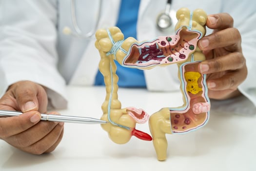 Intestine, appendix and digestive system, doctor holding anatomy model for study diagnosis and treatment in hospital. photo