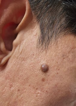 A mole on the face seen up close that enlarges and grows hairs photo
