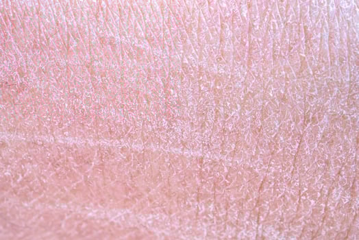 dry and dehydrated human skin texture background photo