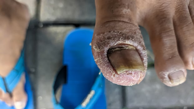 a thumb with onychomycosis disease photo
