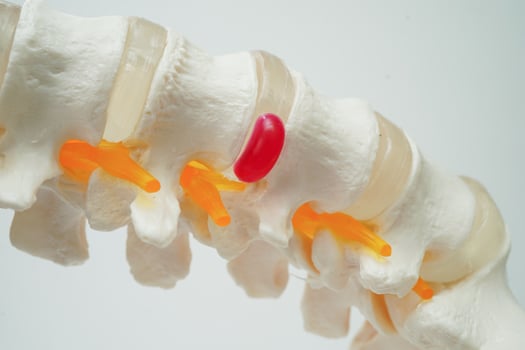 Spinal nerve and bone, Lumbar spine displaced herniated disc fragment, Model for treatment medical in the orthopedic department. photo