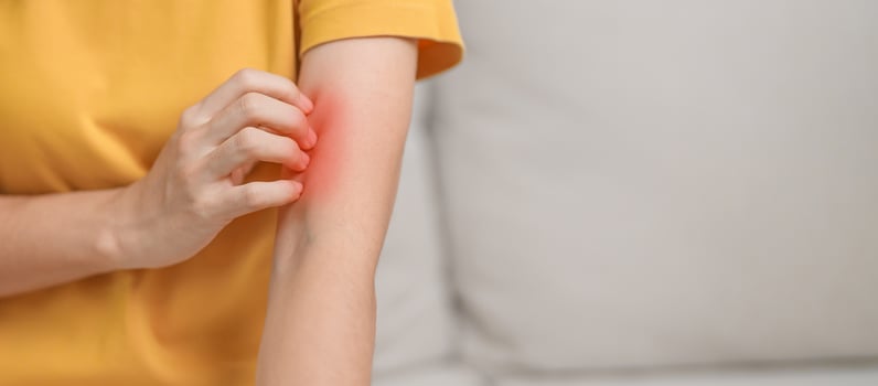 woman itching and scratching itchy arm. Sensitive Skin Allergic reaction to insect bite, food, drug dermatitis. Dermatology, Leprosy day, Systemic lupus erythematosus, Allergy symptoms and rash Eczema photo