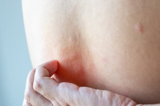 Young asian man itching and scratching on his back from allergic itchy dry skin eczema dermatitis insect bites photo