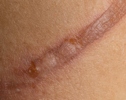 Close-Up of Hand with Burn Injury on Skin Background photo