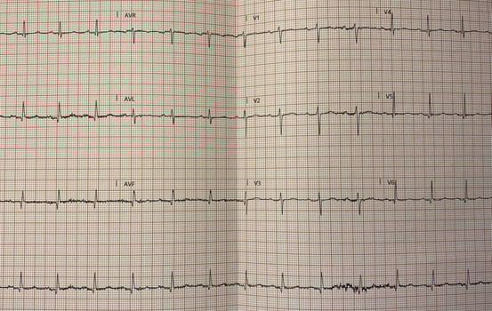 Electrocardiogram in paper form. Electrocardiographic recording. ECG example. photo