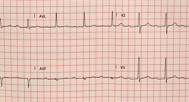 Electrocardiogram in paper form. Electrocardiographic recording. ECG example. photo