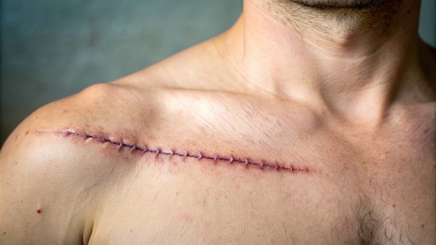 symmetrical, surgery, shoulder, thread, A detailed stock photo featuring a scar from surgery on the shoulder showcasing a symmetrical wound scar with visible threads