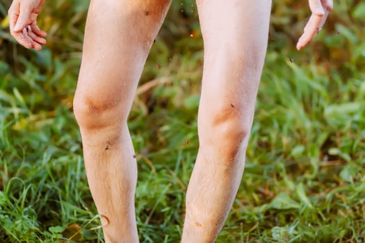 Insect bite on human skin photo