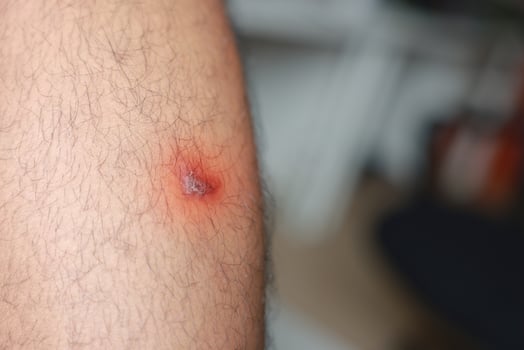 A man verruca vulgaris his leg. Causes of Symptoms of Human Papilloma Virus infection in wounds causes bumps and rough skin. Healthcare medical concept. photo