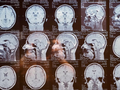 MRI of the human brain of a patient with multiple sclerosis of the initial stage. Close-up X-ray photo