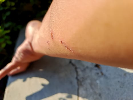 shot of a healing arm with fresh scratches, captured in natural outdoor light. Perfect for health, injury, and recovery themes. photo