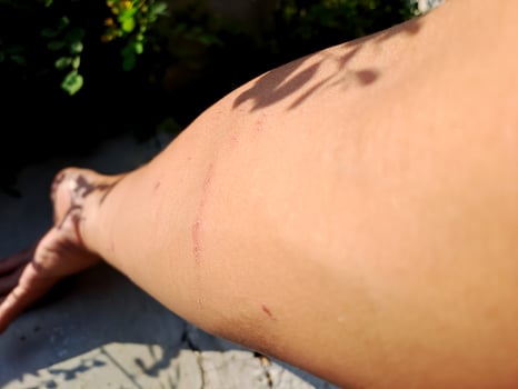 shot of a healing arm with fresh scratches, captured in natural outdoor light. Perfect for health, injury, and recovery themes. photo