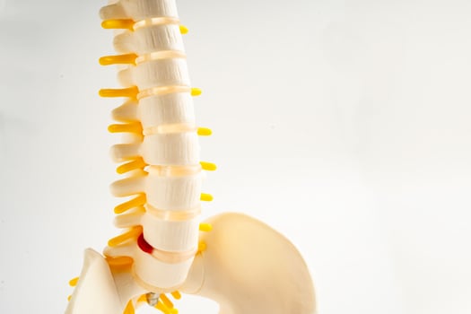 Lumbar spine displaced herniated disc fragment, spinal nerve and bone. Model for treatment medical in the orthopedic department. photo