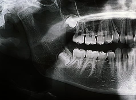 Panoramic X-ray of the jaw. X-ray of the teeth of a 12-year-old girl photo