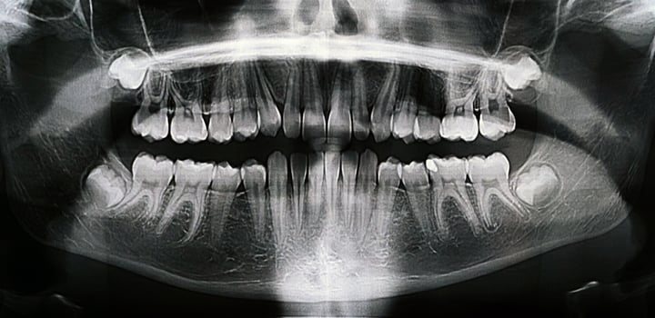 Panoramic X-ray of the jaw. X-ray of the teeth of a 12-year-old girl photo
