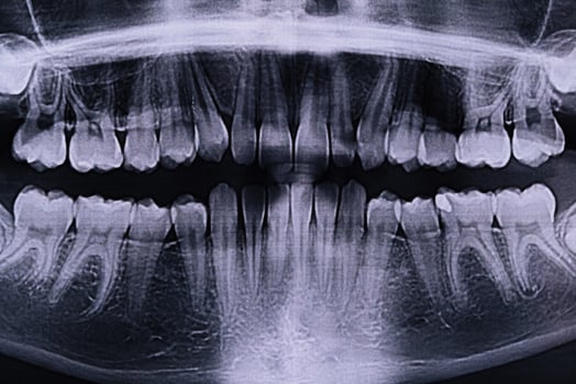 Panoramic X-ray of the jaw. X-ray of the teeth of a 12-year-old girl photo