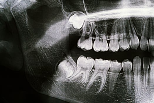 Panoramic X-ray of the jaw. X-ray of the teeth of a 12-year-old girl photo
