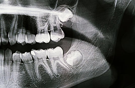 Panoramic X-ray of the jaw. X-ray of the teeth of a 12-year-old girl photo