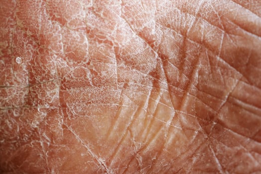 Closeup view of dry human skin . photo