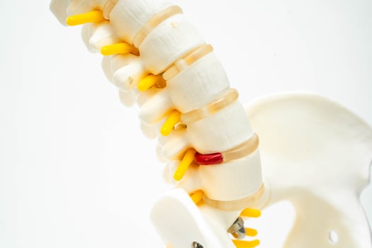 Lumbar spine displaced herniated disc fragment, spinal nerve and bone. Model for treatment medical in the orthopedic department. photo