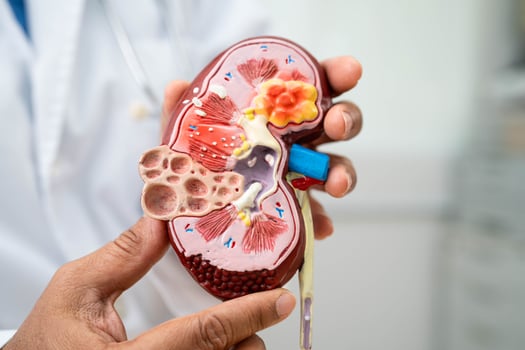 Kidney disease, Chronic kidney disease ckd, Doctor hold human model to treat and study in hospital. photo