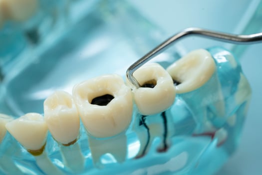 Teeth dental model with tool for dentist use to cleaning care treatment. photo