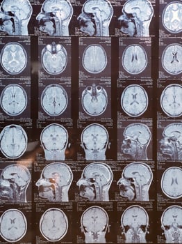 MRI of the human brain of a patient with multiple sclerosis of the initial stage. Close-up X-ray vertical photo
