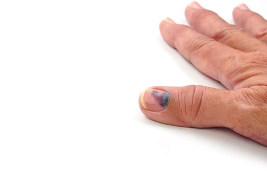 Thumb Finger with Bruised Nail, Subungual Hematoma, on White Background. Painful bruises, accident, injured fingers and medical concept. photo
