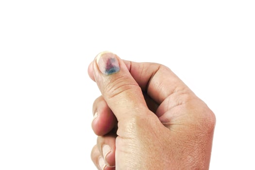 Thumb Finger with Bruised Nail, Subungual Hematoma, on White Background. Painful bruises, accident, injured fingers and medical concept. photo