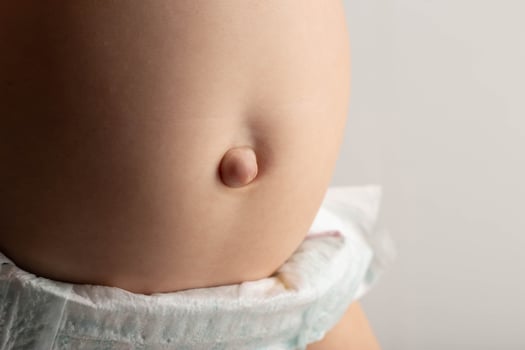 Umbilical hernia in newborns on the stomach, close-up. Treatment of hernias in children without surgery. Convex navel. Children's health. photo
