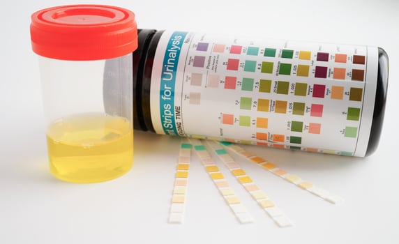 Urinalysis, urine cup with reagent strip pH paper test and comparison chart in laboratory. photo