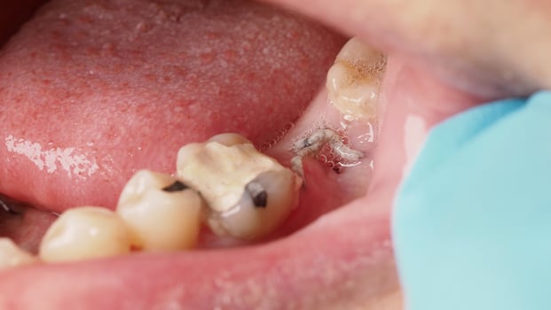 Close up on suture after gum surgery. The molar was extracted and the wound was closed with stitches and adjacent tooth was filled with temporary filling material for root canal treatment. Dental care photo
