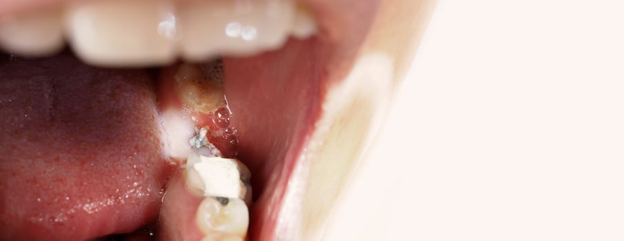 Close up on suture after gum surgery. The molar was extracted and the wound was closed with stitches and adjacent tooth was filled with temporary filling material for root canal treatment. Dental care photo