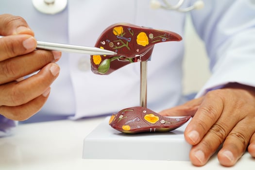 Cirrhosis, Liver cancer, fatty liver, Asian doctor with liver human anatomy model in World Hepatitis Day at hospital. photo