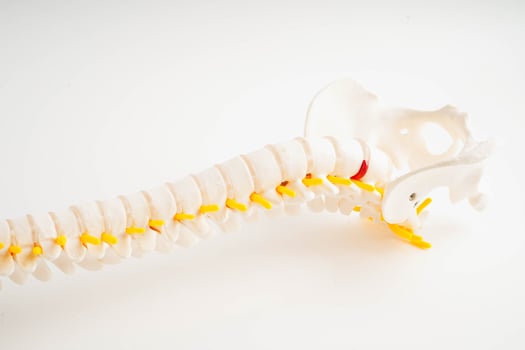 Spinal nerve and bone, Lumbar spine displaced herniated disc fragment, Model for treatment medical in the orthopedic department. photo