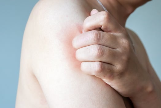 Young asian man itching and scratching on arm from allergic itchy dry skin eczema dermatitis insect bites photo