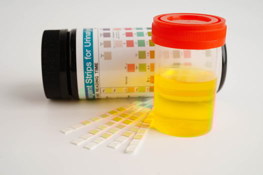 Urinalysis, urine cup with reagent strip pH paper test and comparison chart in laboratory. photo