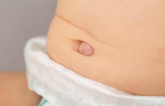 Umbilical hernia in a newborn baby on the stomach. Treatment of umbilical hernias in children without surgery, medical. Close-up photo
