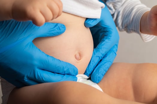 Doctor's hands in blue medical gloves examine an umbilical hernia in a child, close-up. Treatment of umbilical hernias without surgery. photo