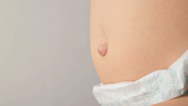 Baby belly with bulging navel on a gray background. Umbilical hernia in newborns, dilated umbilical ring, medical. Copy space for text photo