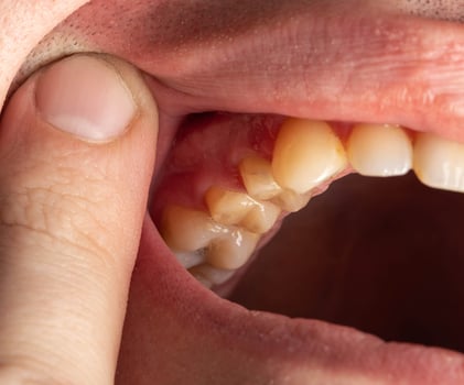 Ground prepared teeth before installing a porcelain fused-to-metal crown for decayed teeth. Prosthetics in dentistry, macro photo