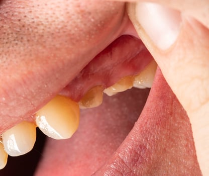 Grind teeth under a metal-ceramic crown in a man's mouth. Dental prosthetics in dental orthopedics, macro photo