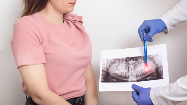The doctor holds a panoramic X-ray picture of the patient s teeth with a sick semi-urethinal wisdom tooth. Wisdom teeth extraction concept in dentistry photo