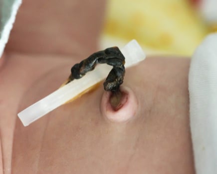 The remains of the umbilical cord in a baby after birth. Healing of the umbilical wound and umbilical ring, close-up. photo