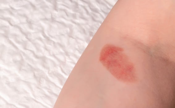 Red spot on the skin, skin damage from a burn on the arm. Copy space for text photo