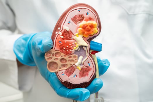 Kidney disease, Chronic kidney disease ckd, Doctor hold human model to treat and study in hospital. photo